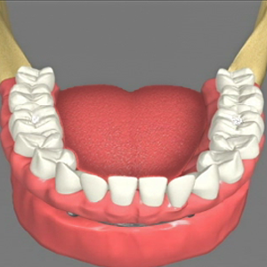 Implant supported dentures