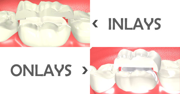 Dental Inlay & Onlay : What's The Difference