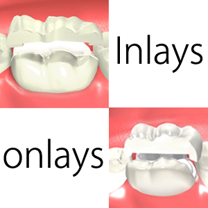 Dental Inlay & Onlay : What's The Difference