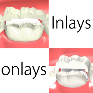 Porcelain Inlays and Onlays Porcelain Inlays and Onlays Rancho Mirage, Palm Desert, Palm Spring, Coachella Valley, Cathedral City, La Quinta, Desert Hot Springs, Yucca Valley, Indian Wells