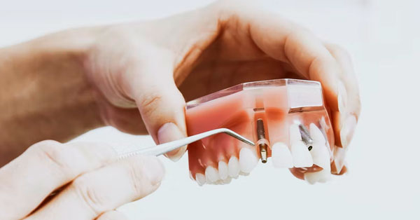 7 Myths Surrounding Dental Implants | Rancho Mirage, CA