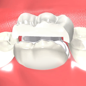 Porcelain Onlays in Rancho Mirage Porcelain Onlays in Rancho Mirage