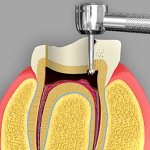 Root Canal Treatment in Rancho Mirage, Palm Desert, Palm Spring, Coachella Valley, Cathedral City, La Quinta, Desert Hot Springs, Yucca Valley, Indian Wells