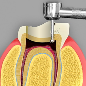 Endodontics Rancho Mirage, Palm Desert, Palm Spring, Coachella Valley, Cathedral City, La Quinta, Desert Hot Springs, Yucca Valley, Indian Wells