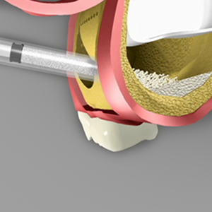 Sinus Graft Rancho Mirage, Palm Desert, Palm Spring, Coachella Valley, Cathedral City, La Quinta, Desert Hot Springs, Yucca Valley, Indian Wells