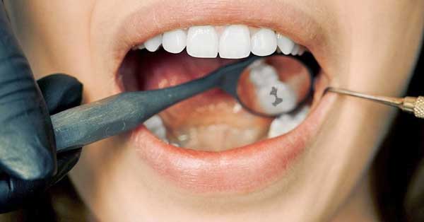 When to Pull a Tooth and When to Do a Root Canal