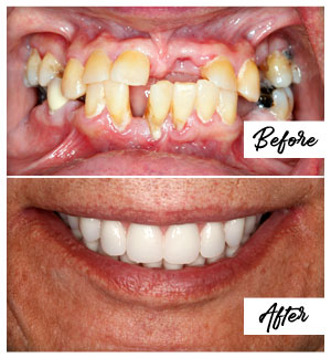 Dental Implants Case 15