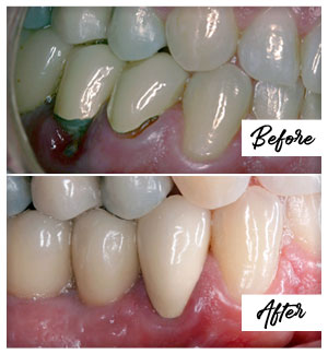 Dental Implants Case 12